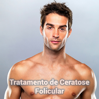 Tratamento de Ceratose Folicular Dermo Essence em Aracaju-SE